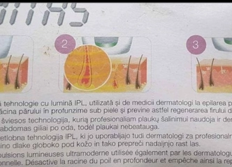 IPL technologija rankoms, kojoms, veidui ir bikini